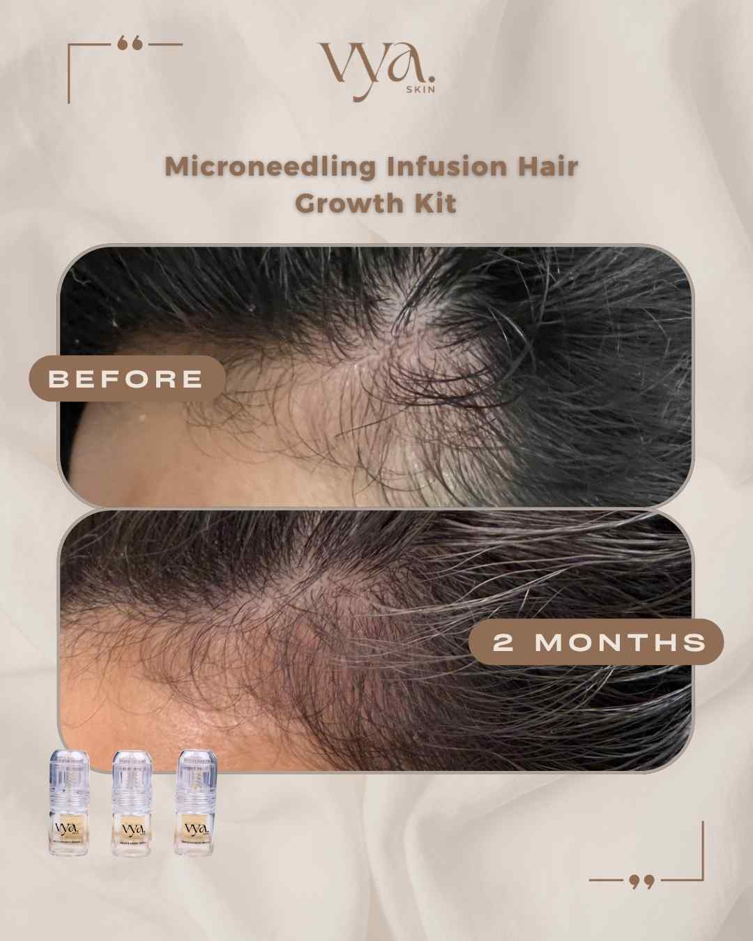 Hair Growth Microinfusion Kit