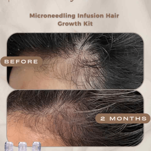Hair Growth Microinfusion Kit - VYA Skin