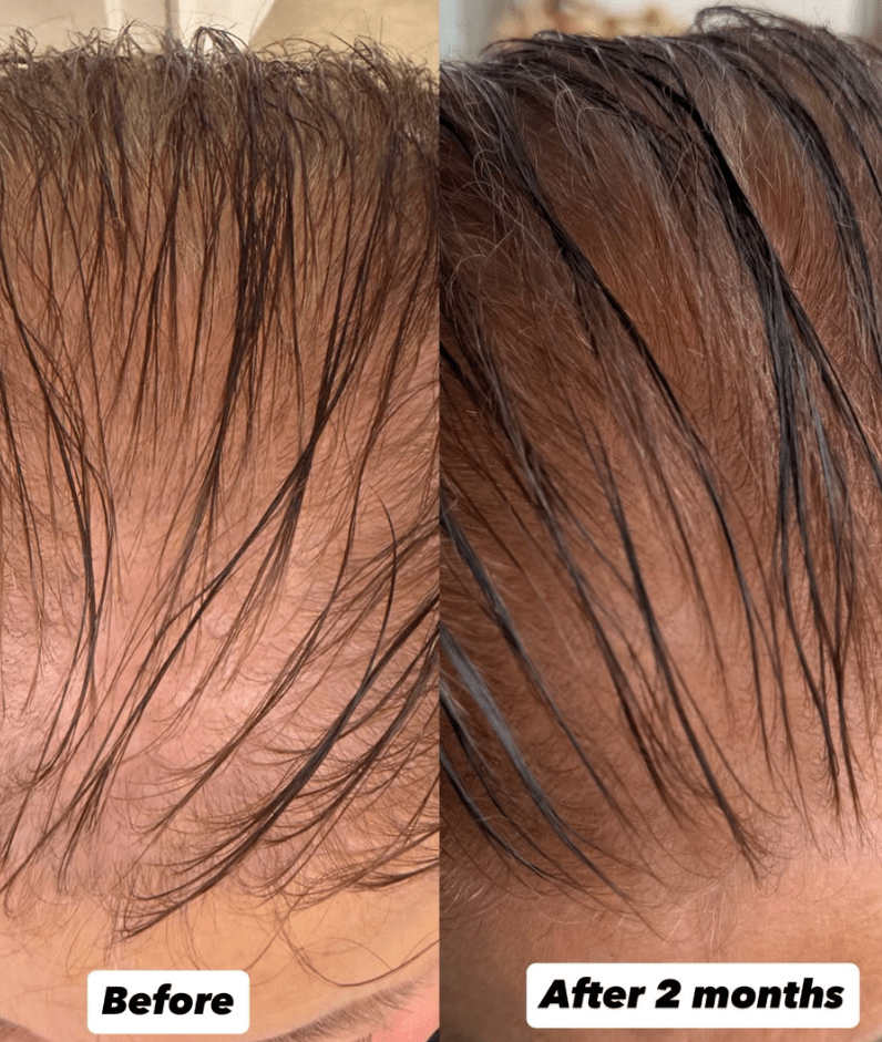 Hair Growth Microinfusion Kit - VYA Skin
