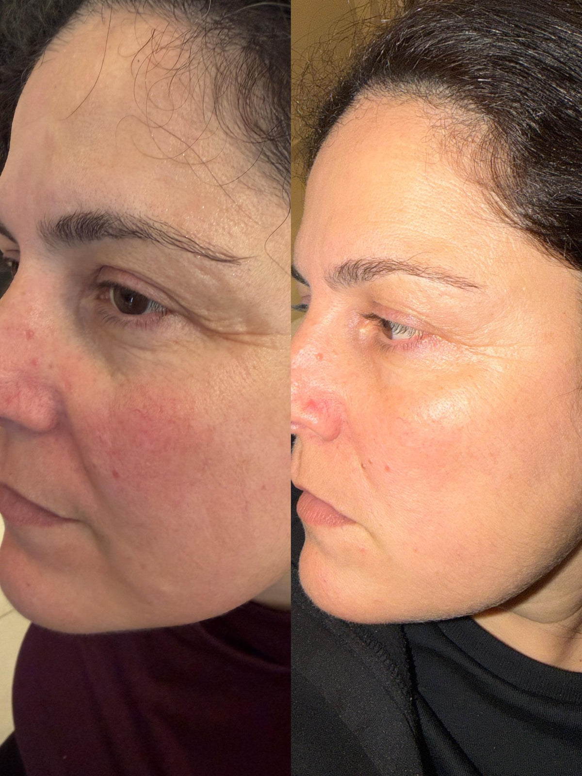 Anti-Aging Microinfusion Kit - VYA Skin