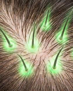 VYA skin microneedling infusion hair growth system