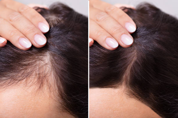 before and after results showing reduced hair thinning and improved hair density using micro infusion treatment