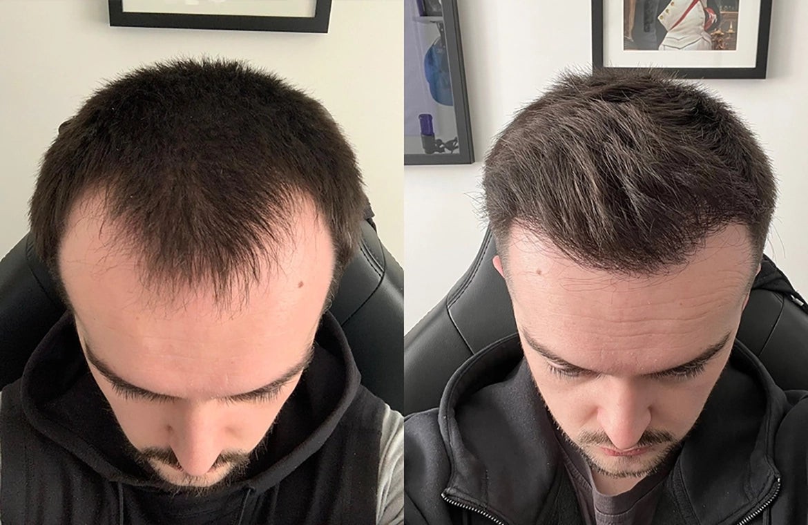before and after results showing reduced hair thinning and improved hair density using micro infusion treatment