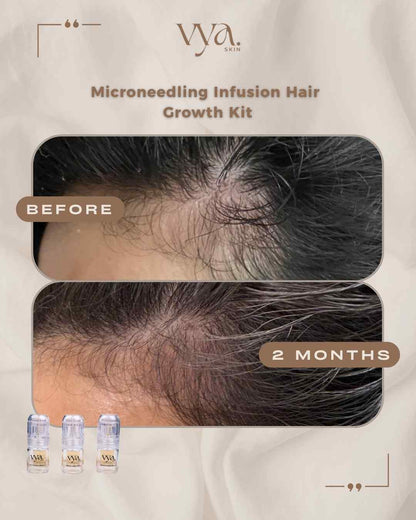 Hair Growth Microinfusion Kit