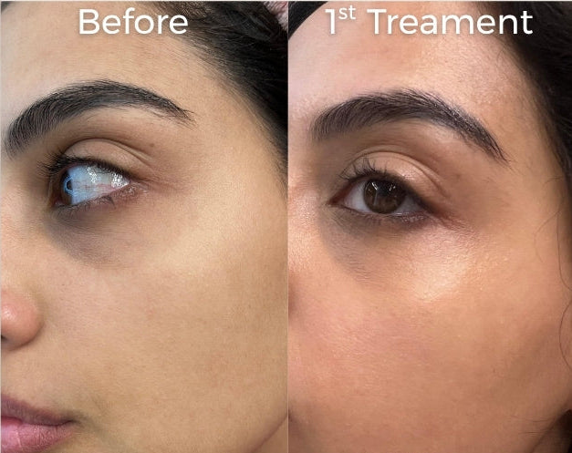 before and after skin transformation showing improved texture reduced redness and smoother skin after VYA Skin Microneedling Infusion 