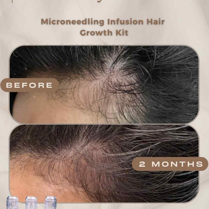 Hair Growth Microinfusion Kit