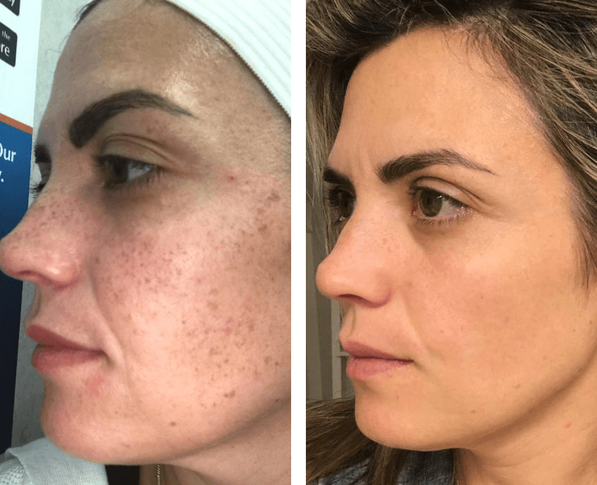 Joelle's skin before and after three VYA micro-infusion treatments: faded pigmentation and softer fine lines