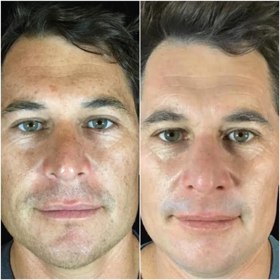 Marc's face before and after VYA micro-infusion: smoother texture and healthier-looking skin