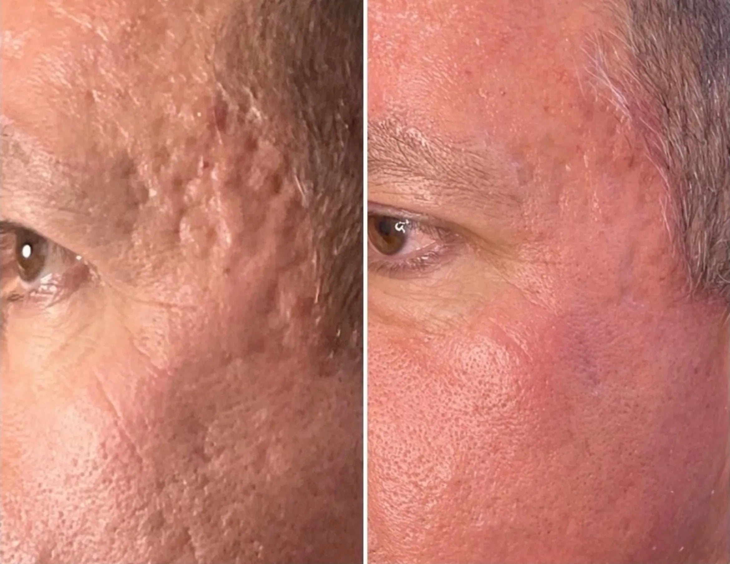 before and after skin transformation showing improved texture reduced redness and smoother skin after VYA Skin Microneedling Infusion 