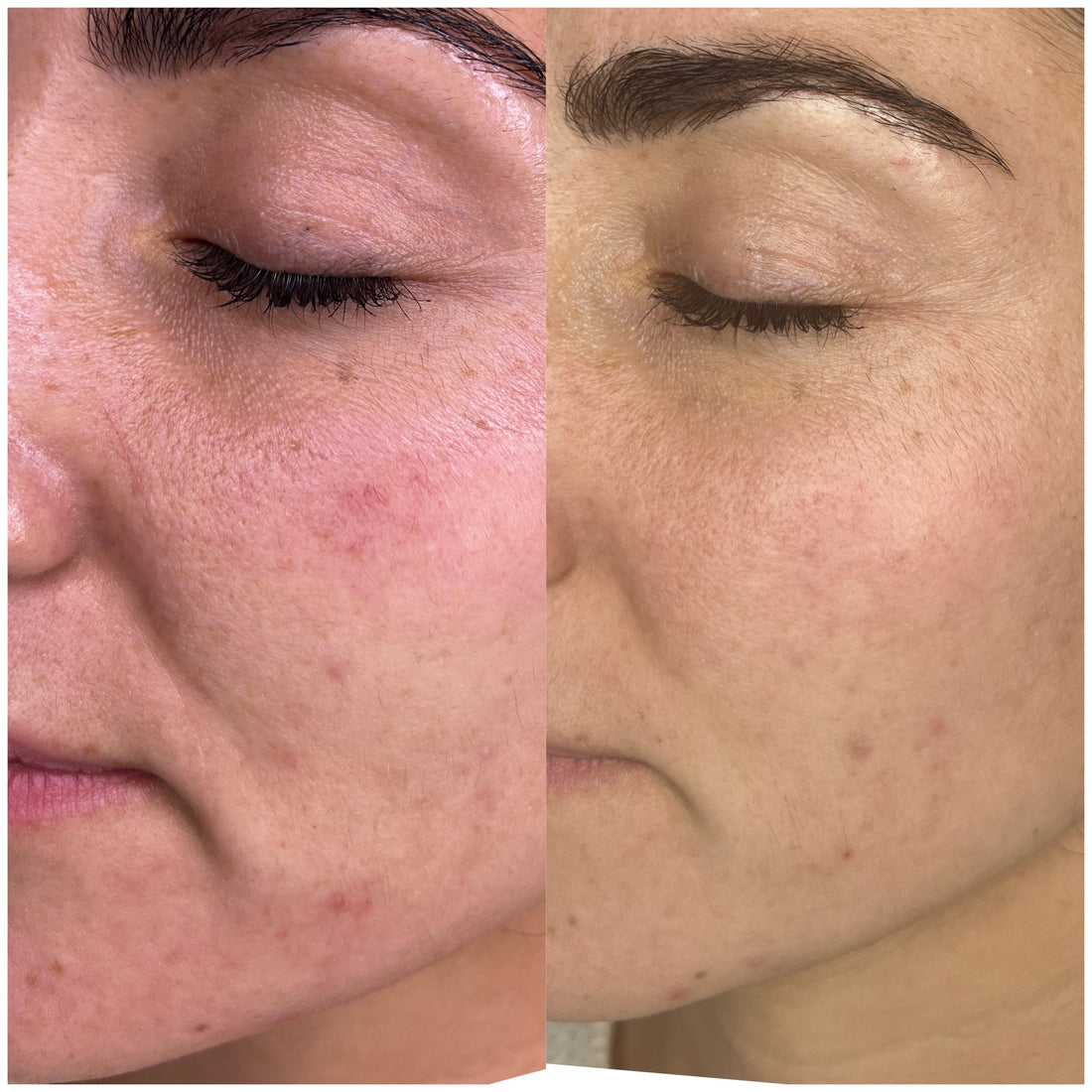 Nour's cheek before and after VYA micro-infusion: calmer redness and a more even skin tone