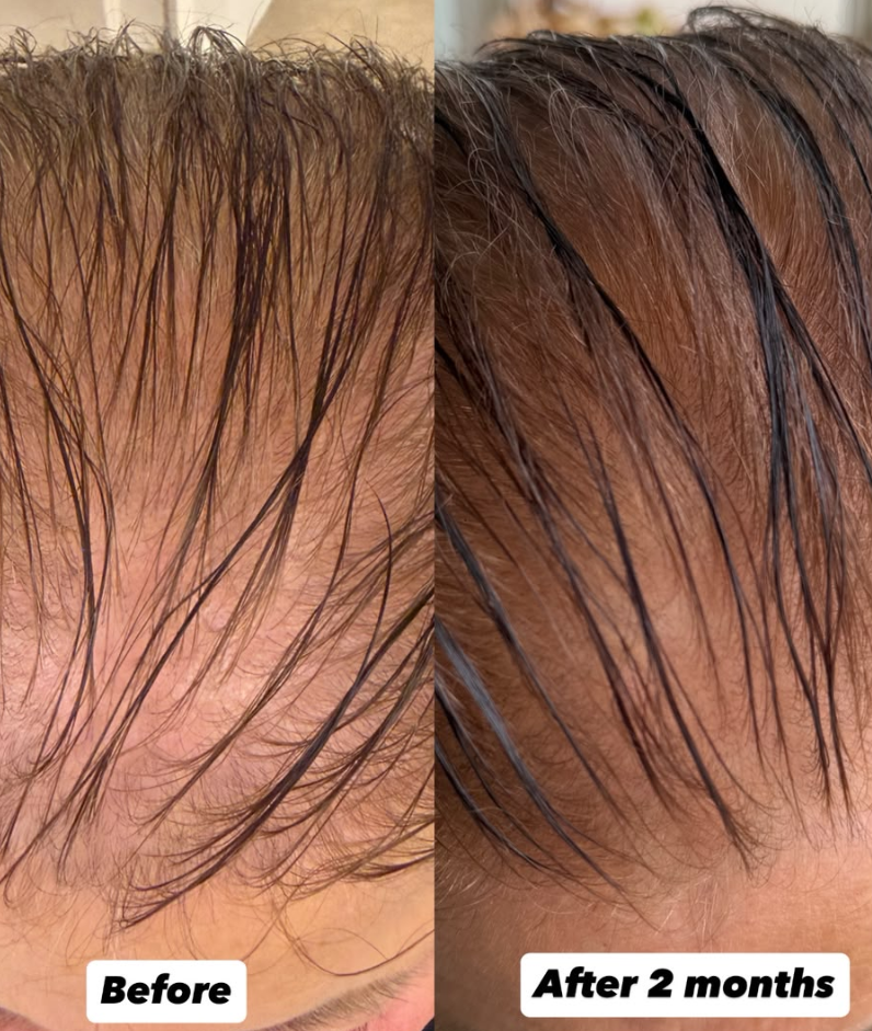 Hair Growth Microinfusion Kit