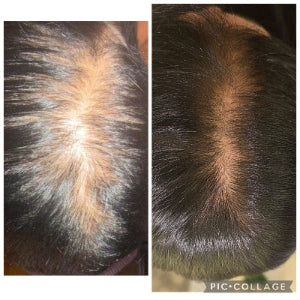 A side-by-side before-and-after comparison of a person's scalp, showing thinning hair and increased baldness on the left, and fuller, denser hair on the right after using VYA Microneedling Infusion Hair growth treatment at home for 6 weeks