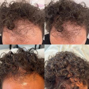 Hair Growth Microinfusion Kit - VYA Skin