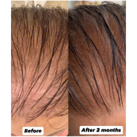 Before and after comparison of hair growth microneedling infusion from VYA skin on a 78 year old female