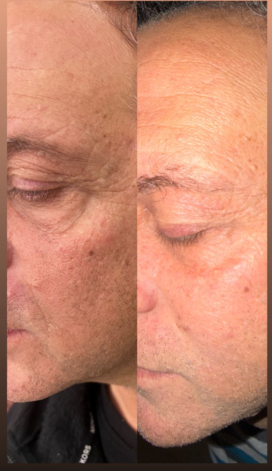 Anti-Aging Microinfusion Kit