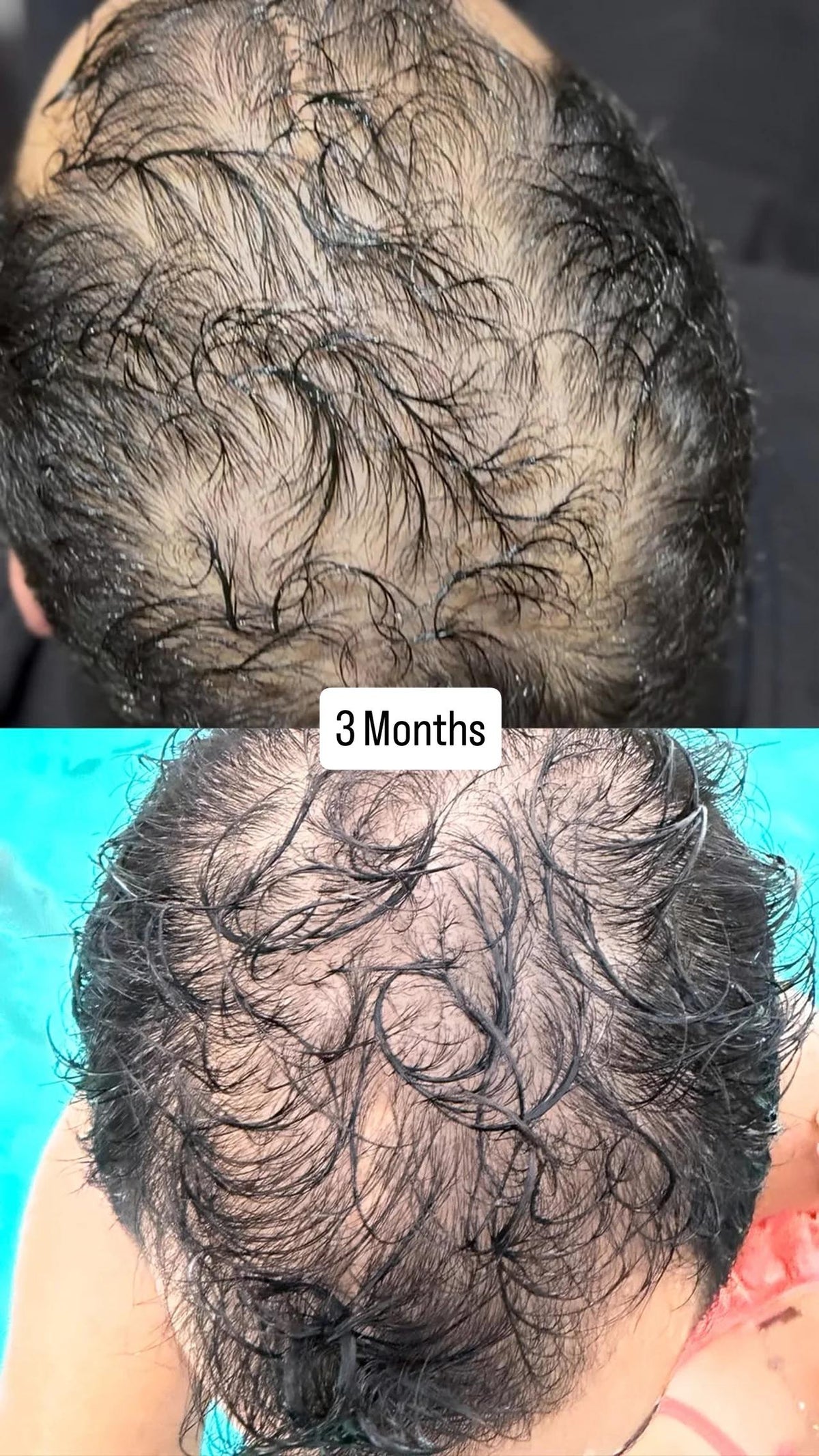 Hair Growth Microinfusion Kit - VYA Skin