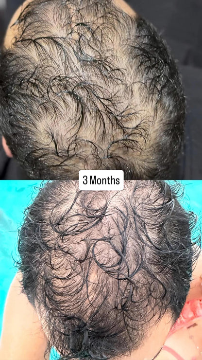 Hair Growth Microinfusion Kit - VYA Skin