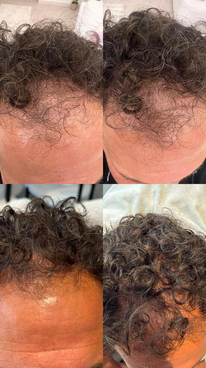 Hair Growth Microinfusion Kit